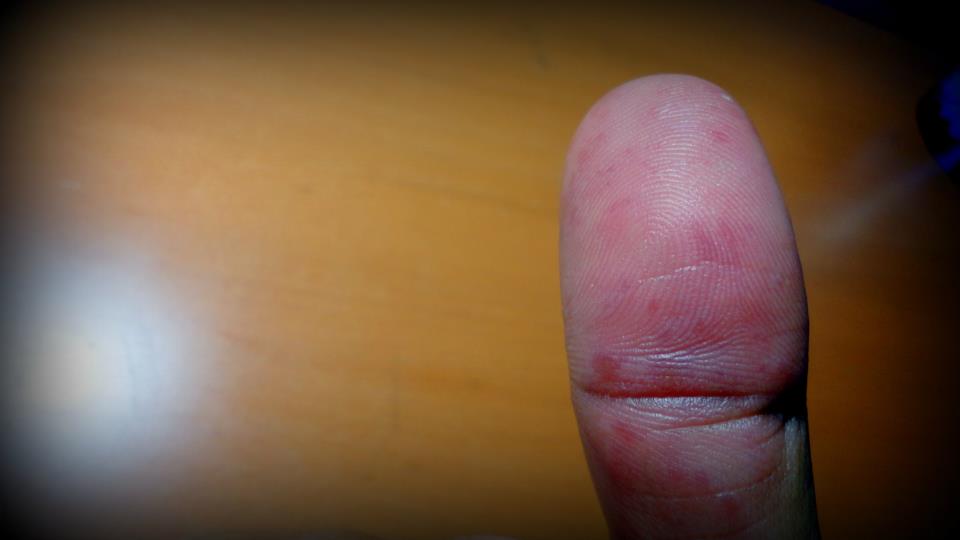 blisters on thumb